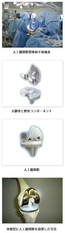 人工膝関節置換術