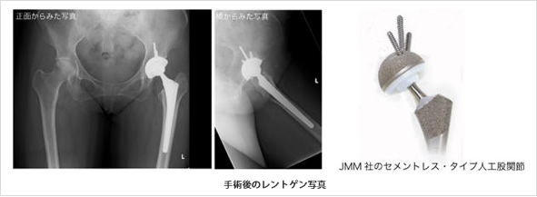人工関節に置き換えて痛みなく関節が動くようにする手術