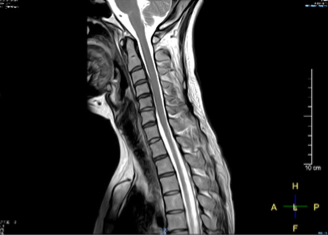 【頸椎MRI】